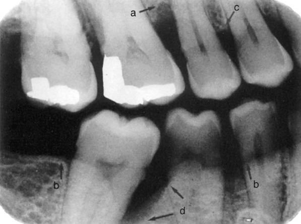 Periodontal Bone Loss