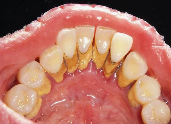 Periodontitis